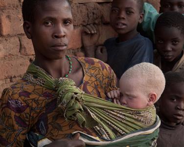 African albinism attacks investigated on <i>Special Assignment</i> 